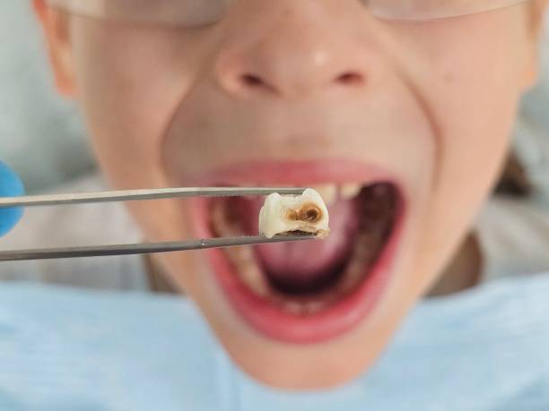Best Emergency Dental Care for Broken or Chipped Teeth in Port Barrington, IL